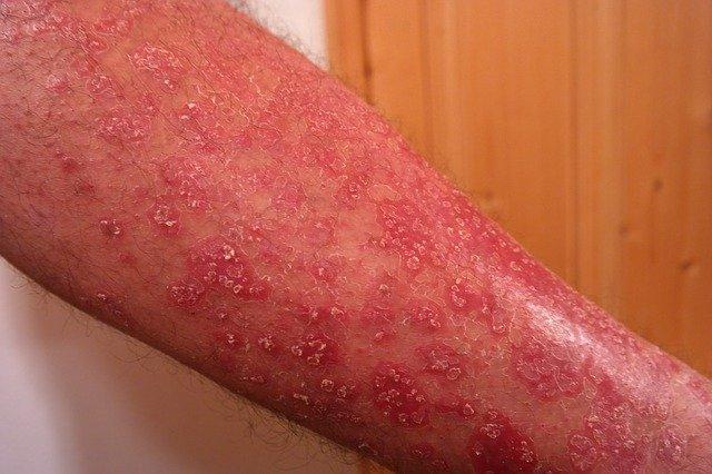 12 basic tips to plan an Indian diet for psoriasis